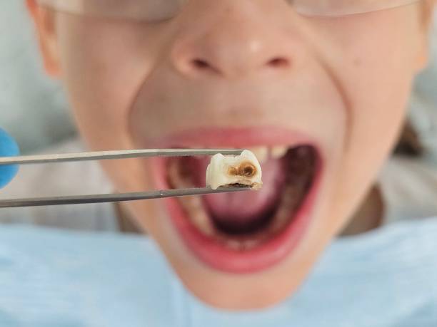 Best Emergency Treatment for Dental Infections or Abscesses in Palo Alto, CA