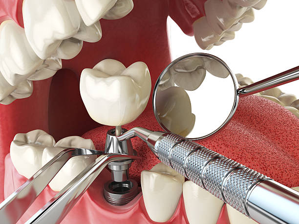 Best Urgent Care for Lost Fillings or Crowns in Palo Alto, CA
