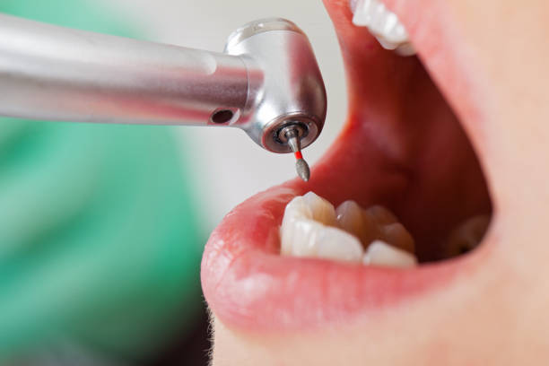 Best Emergency Wisdom Teeth Removal in Palo Alto, CA